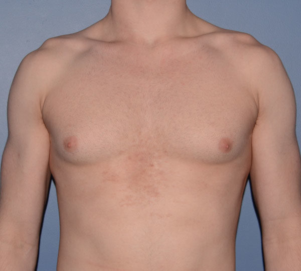 Male Breast Reduction