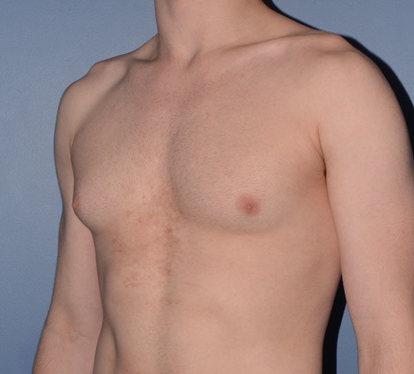 Male Breast Reduction