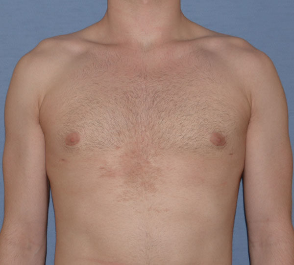 Male Breast Reduction