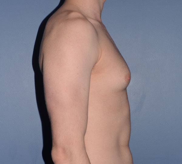 Male Breast Reduction