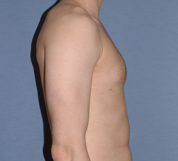 Male Breast Reduction