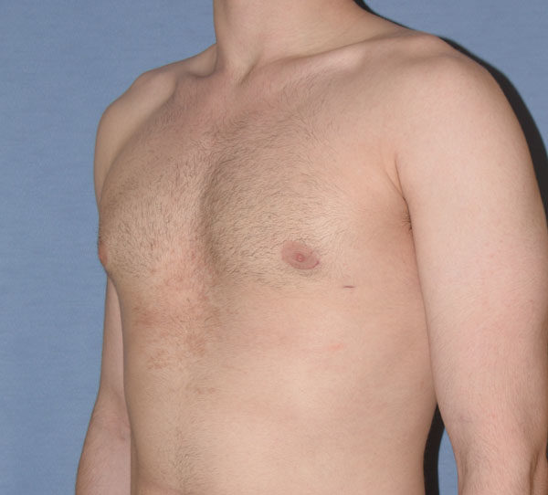 Male Breast Reduction