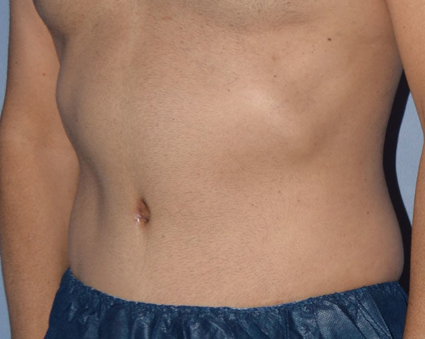 Tummy Tuck