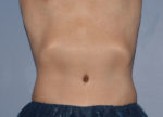 Tummy Tuck