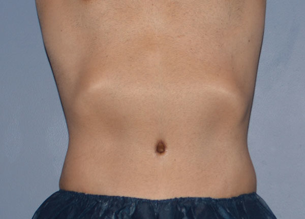 Tummy Tuck