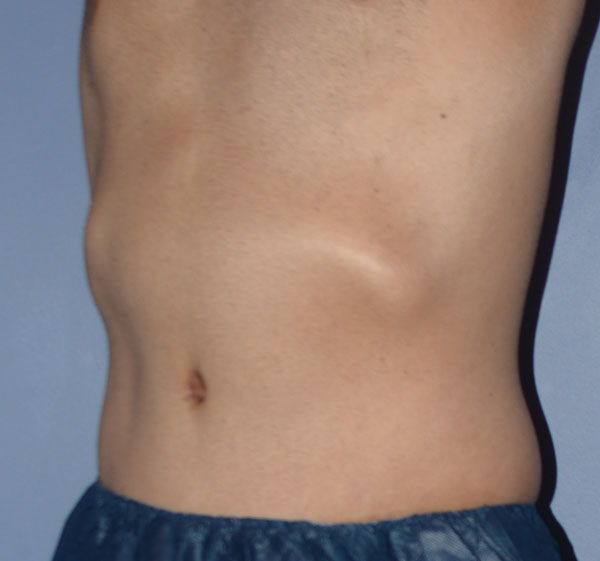 Tummy Tuck