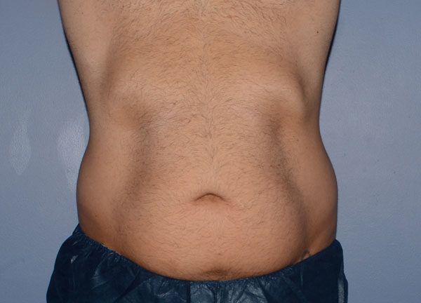 Tummy Tuck