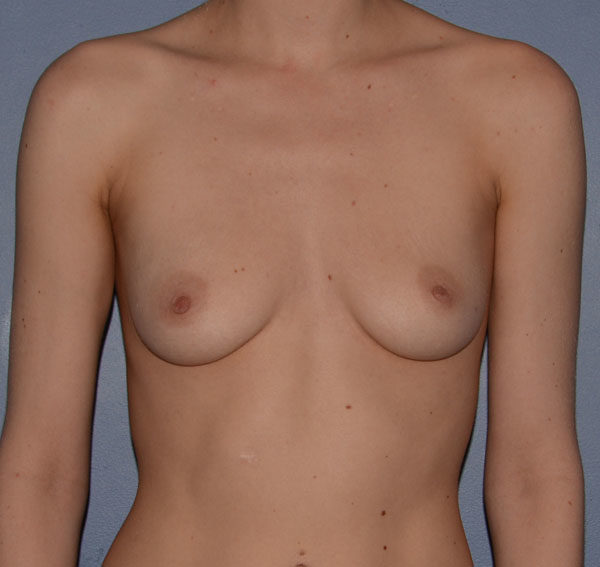 Breast Augmentation Implants