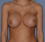 Breast Augmentation Implants