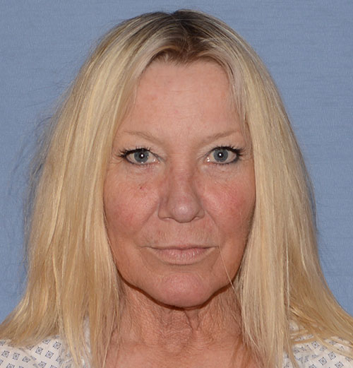Facelift