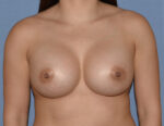 Breast Augmentation Implants