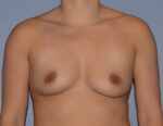 Breast Augmentation Implants