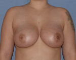 Breast Augmentation Implants