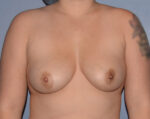 Breast Augmentation Implants