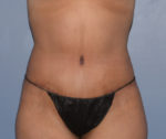 Tummy Tuck