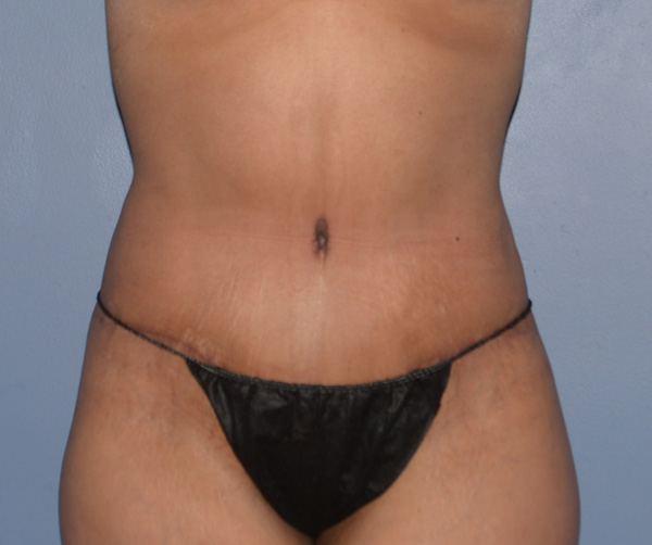 Tummy Tuck