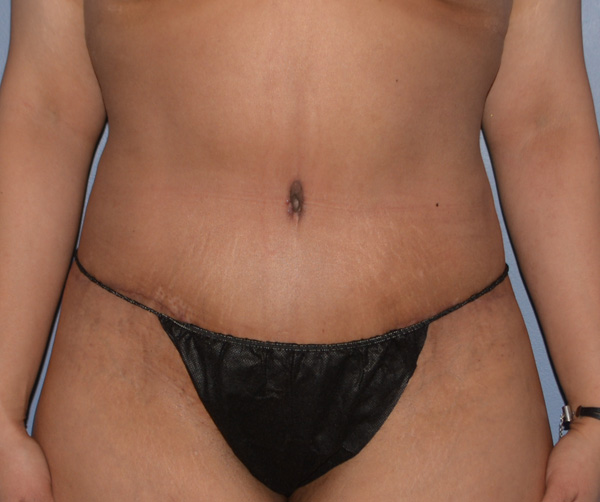 Tummy Tuck