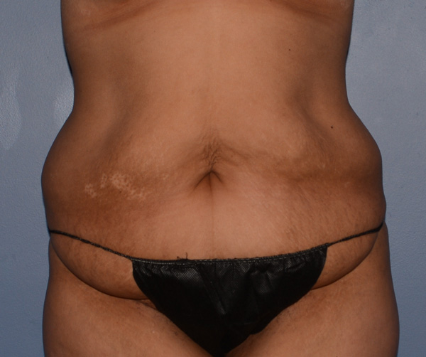 Tummy Tuck