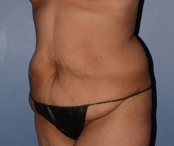 Tummy Tuck