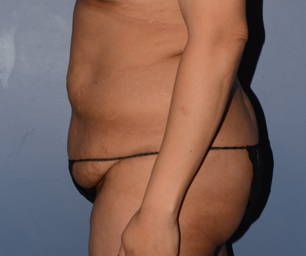 Tummy Tuck