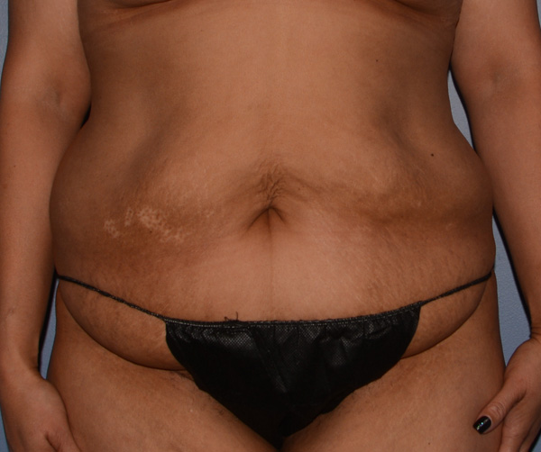 Tummy Tuck