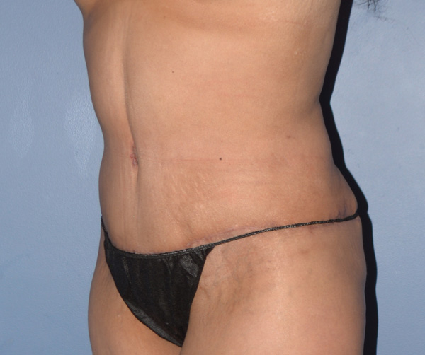 Tummy Tuck