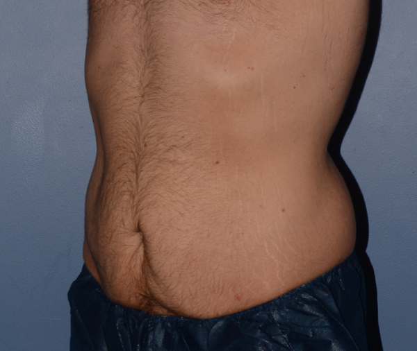 Tummy Tuck