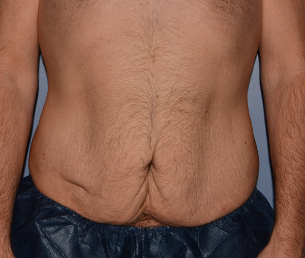 Tummy Tuck