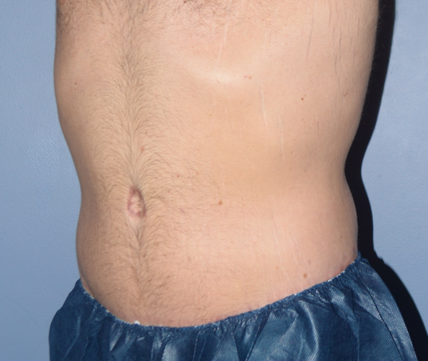 Tummy Tuck