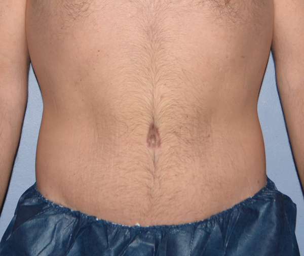 Tummy Tuck