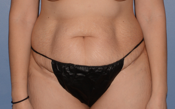 Tummy Tuck