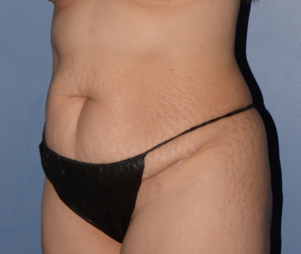 Tummy Tuck