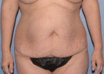 Tummy Tuck