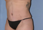 Tummy Tuck