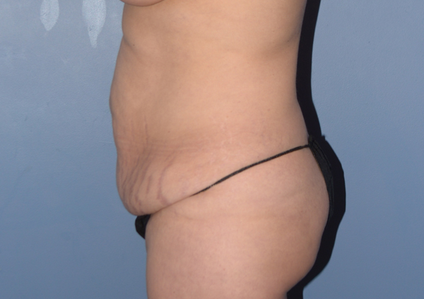Tummy Tuck