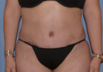 Tummy Tuck