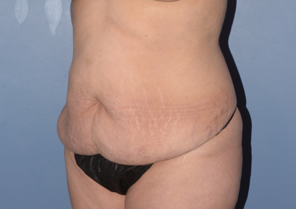Tummy Tuck