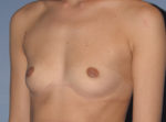 Breast Augmentation Implants