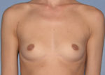 Breast Augmentation Implants