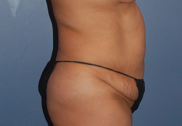 Tummy Tuck