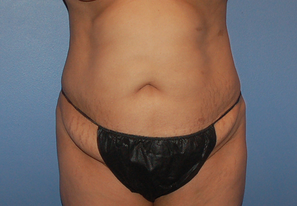 Tummy Tuck