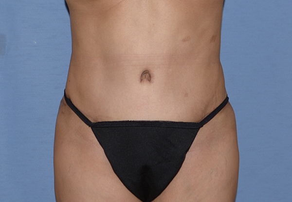 Tummy Tuck