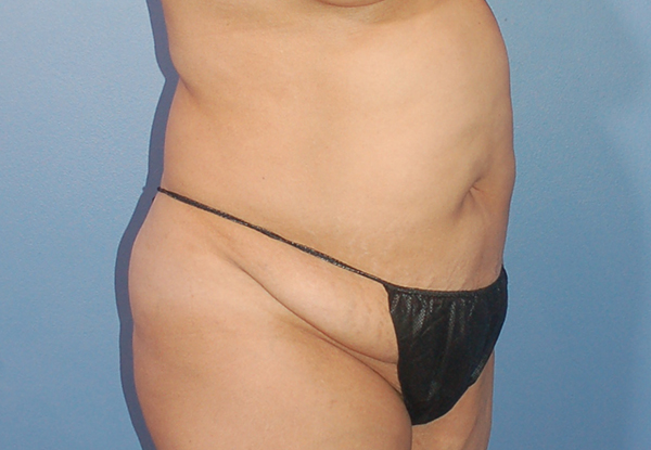 Tummy Tuck