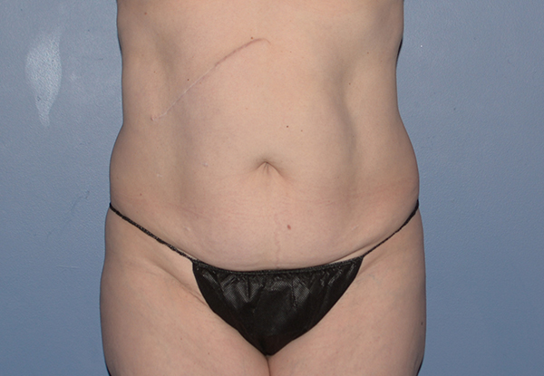 Tummy Tuck