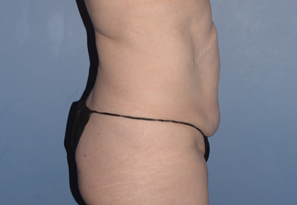 Tummy Tuck