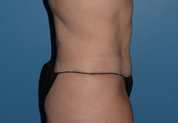 Tummy Tuck