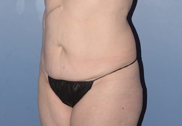 Tummy Tuck