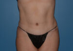 Tummy Tuck