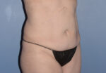 Tummy Tuck