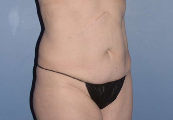 Tummy Tuck